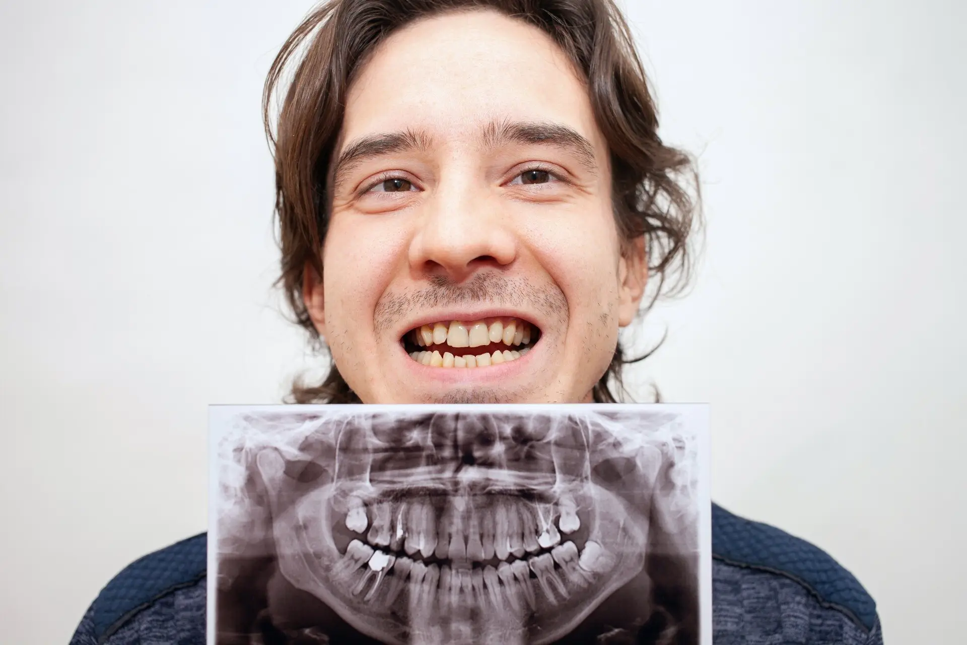 Smiling man holding his panoramic dental X-ray below his crowded teeth