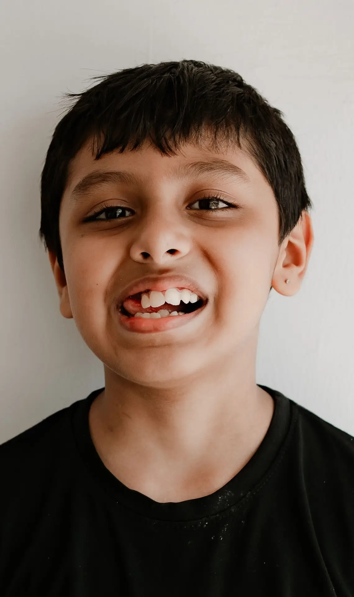 Boy smiling to show crowded, misaligned teeth