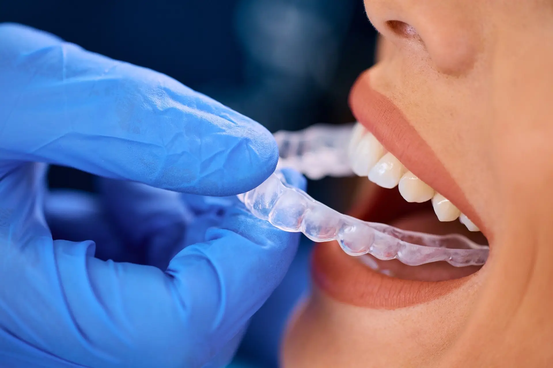 Clear aligner being fitted over the teeth