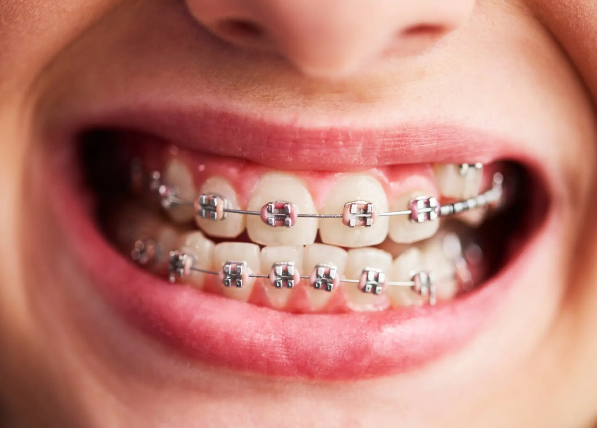 Close-up of upper and lower metal braces