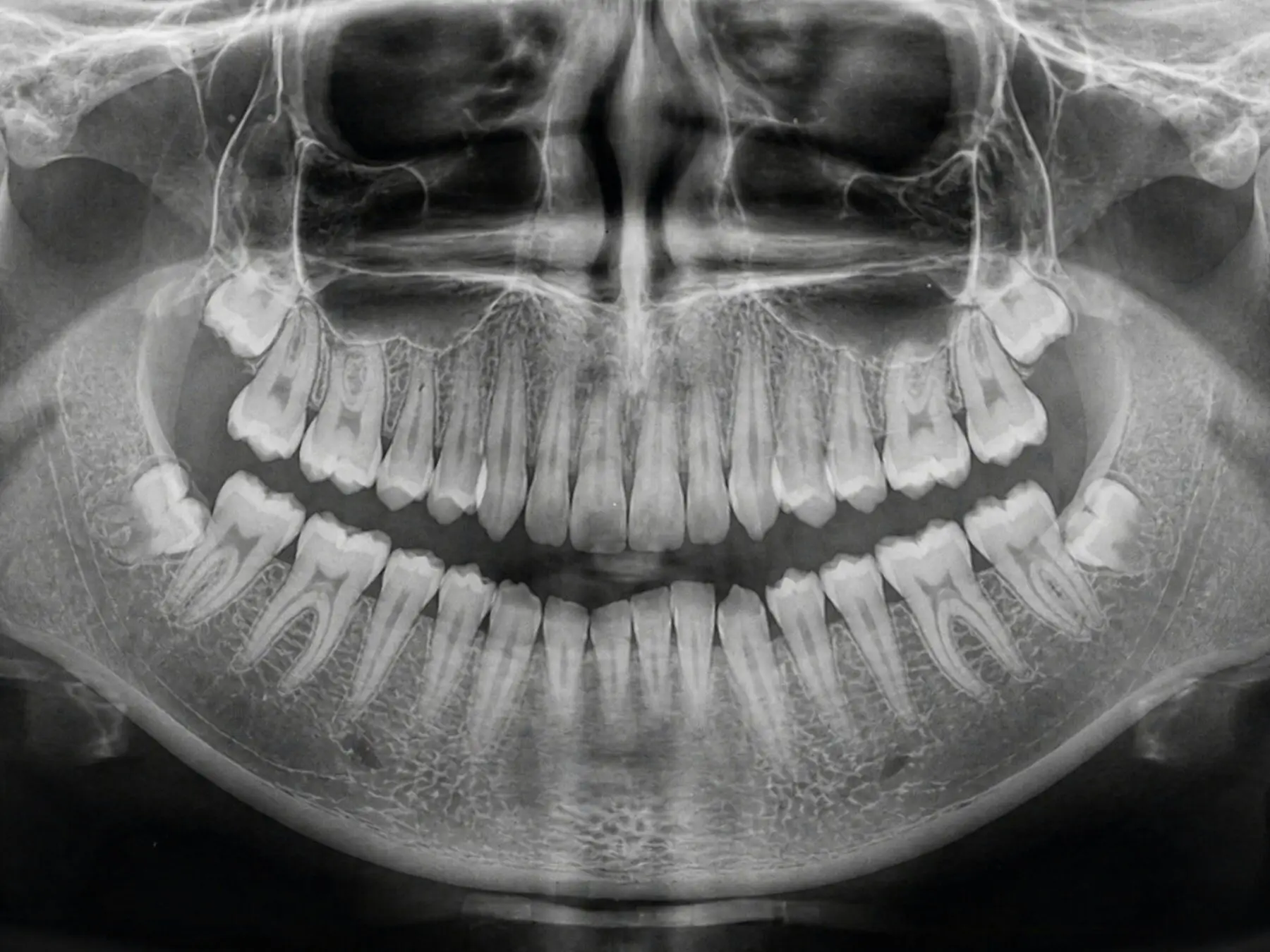 Panoramic X-ray showing the teeth and jawbone